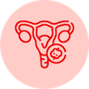 Ovarian Cancer